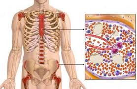 Polycythemia Life Insurance